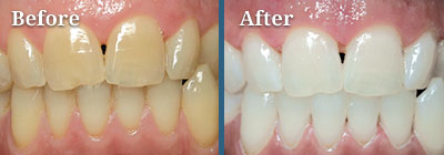 Custom Whitening Trays at Lumber River Dental