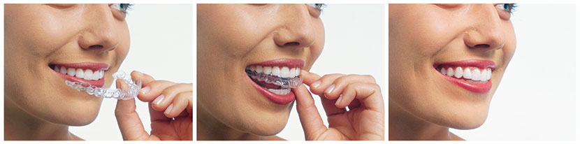 Invisalign Aligners - Lumberton NC Dentist Lumber River Dental